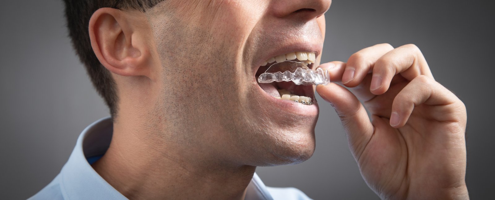 Online clear aligner treatment planning support for dentists