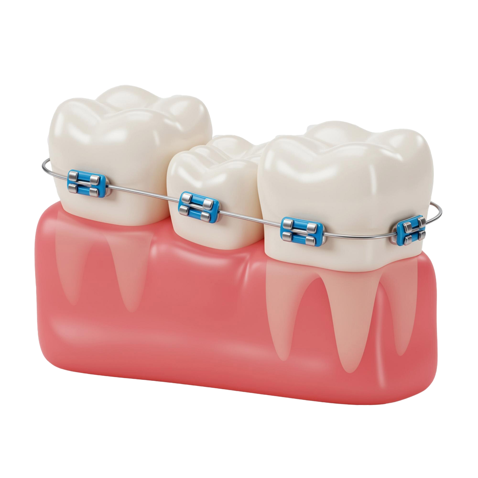 Braces Treatment Process