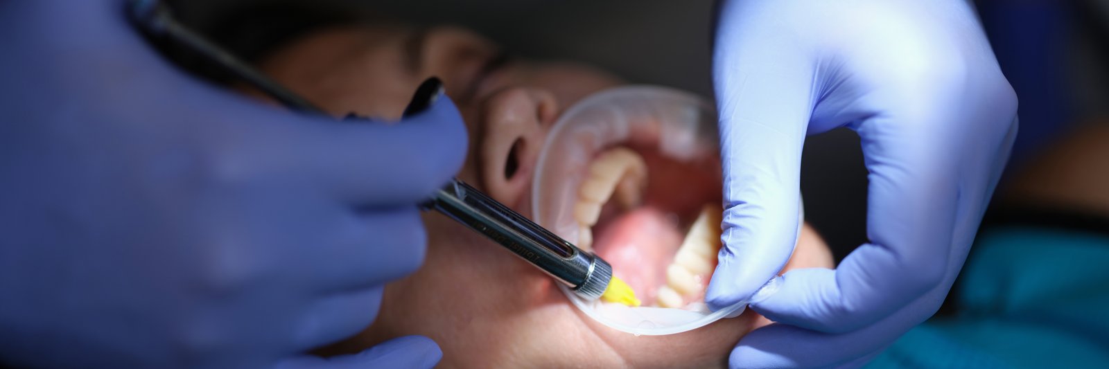 Restorative Dental Treatment Pune