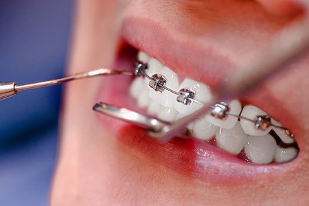 Advanced Dental Braces Treatment in Pune